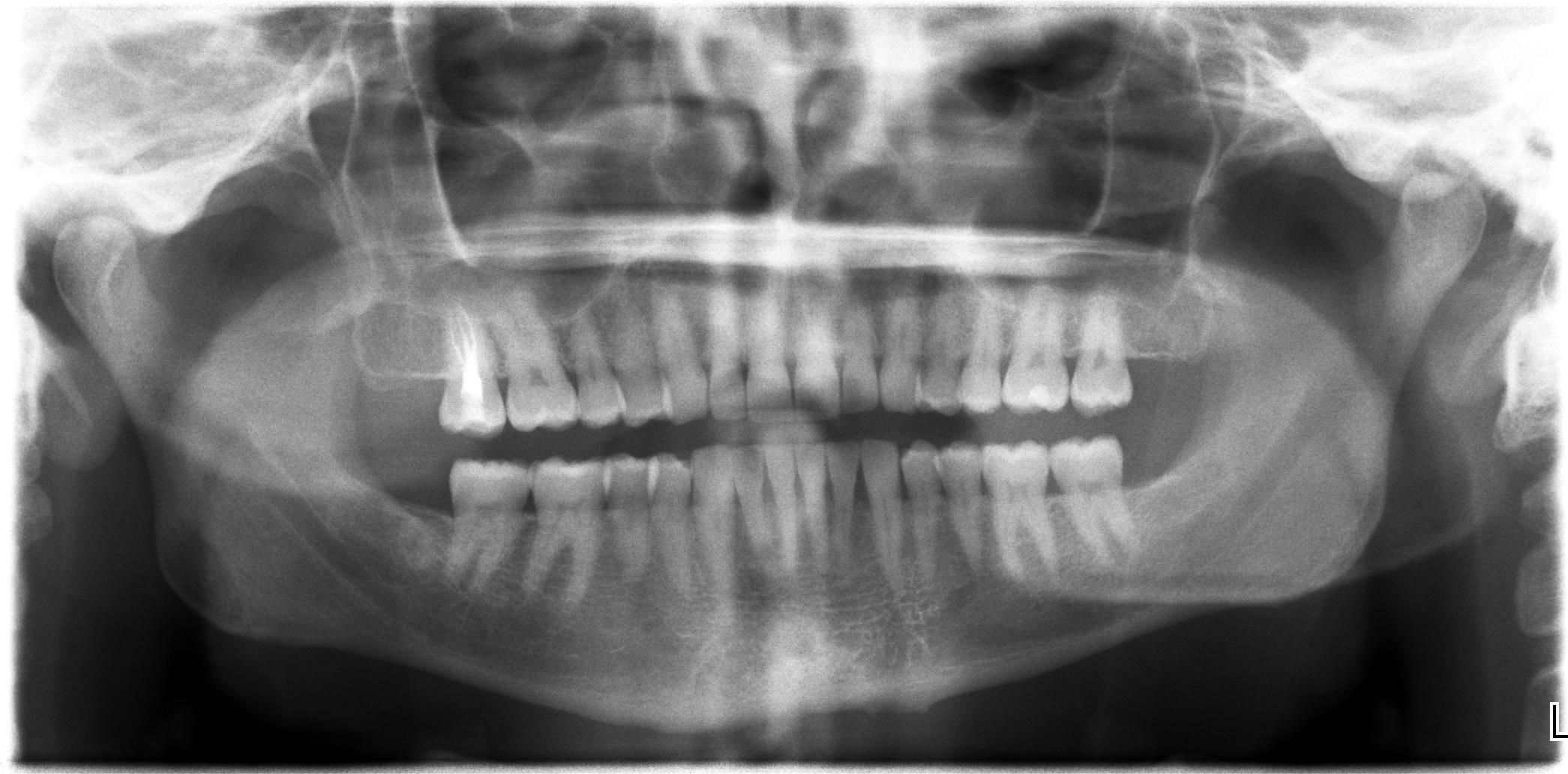 Panoramica Dentale: Costo della Radiografia ai Denti per Adulti e Bambini